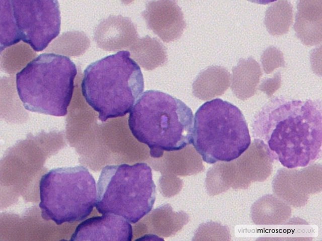 Prominent Nucleolus - Acute Myeloid Leukaemia