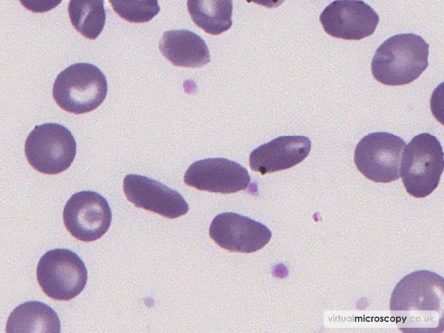 Boat Shaped Cells - Sickle Cell Anaemia