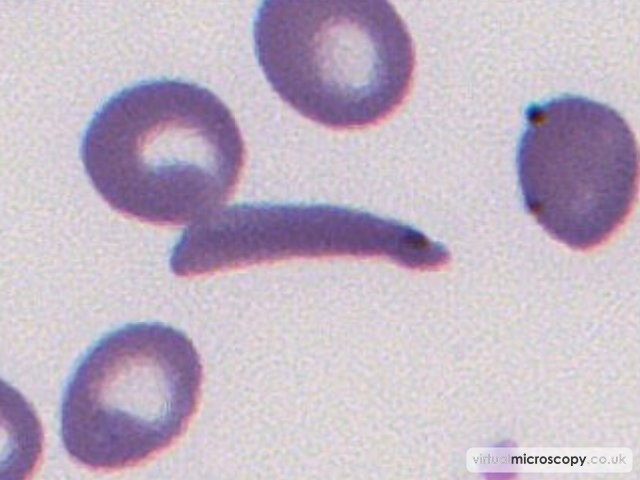 Sickle Cell - Sickle Cell Anaemia