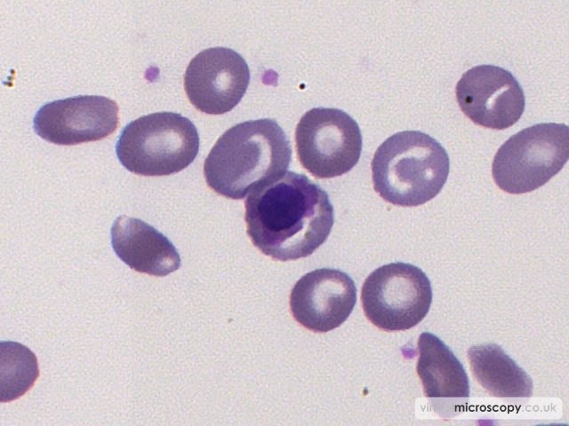 Nucleated Red Blood Cell - Sickle Cell Anaemia