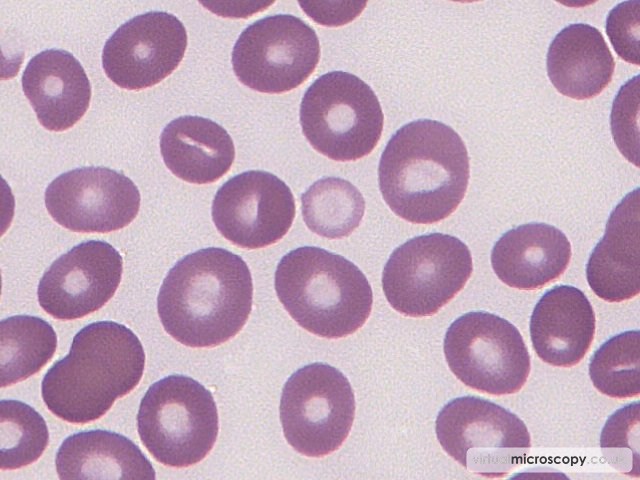 Oval Macrocytes - B12 Deficiency