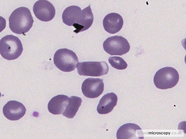 Retracted Haemoglobin - Sickle Cell Anaemia