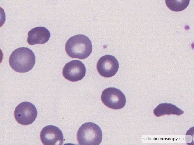 Normal RBC - Sickle Cell Anaemia