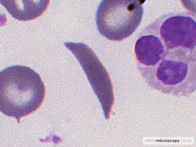 Boat Cell - Sickle Cell Anaemia