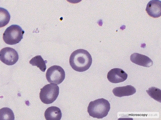 Target Cell - Sickle Cell Anaemia