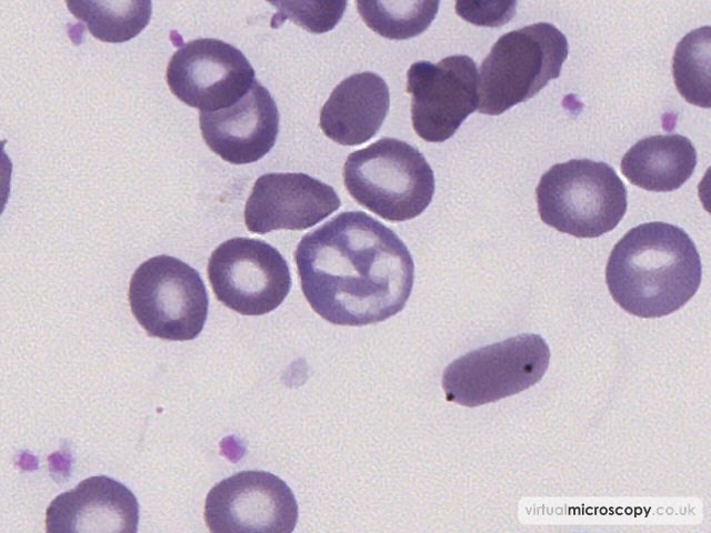 Abnormal Haemoglobinisation - Sickle Cell Anaemia