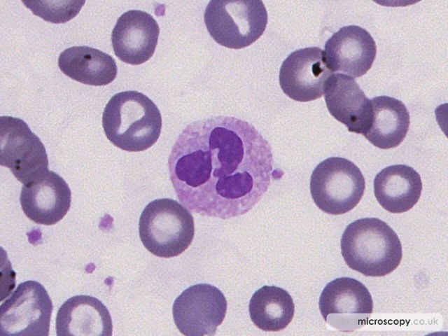Reactive Neutrophil - Sickle Cell Anaemia