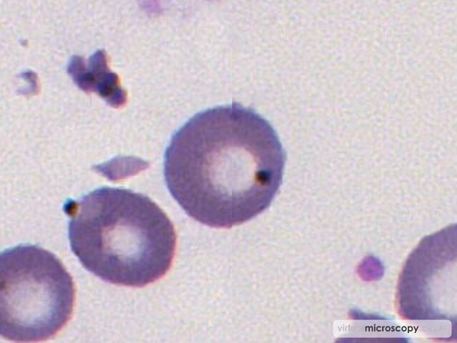 Howell Jolly Body - Sickle Cell Anaemia