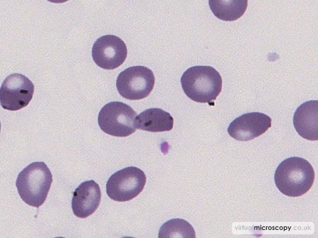 Pappenheimer Bodies - Sickle Cell Anaemia