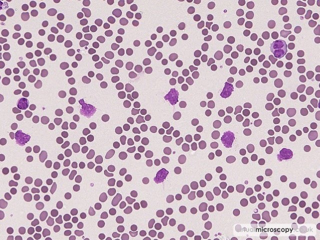 Smear Cells - Chronic Lymphocytic Leukaemia