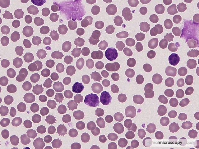Small Mature Lymphocytes - Chronic Lymphocytic Leukaemia