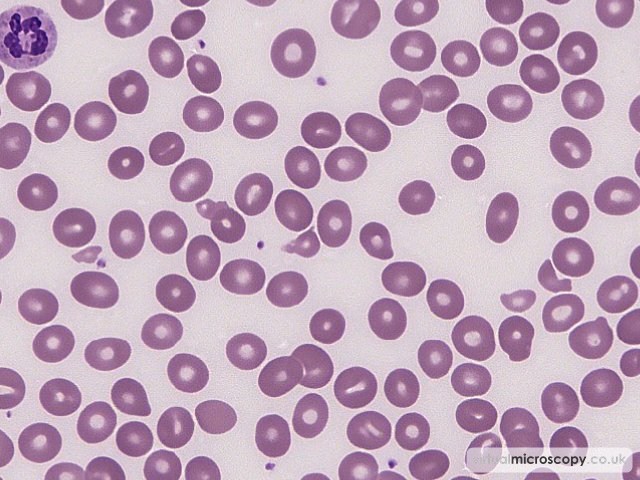 Red cell fragments - B12 Deficiency