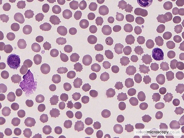 EDTA change - Chronic Lymphocytic Leukaemia