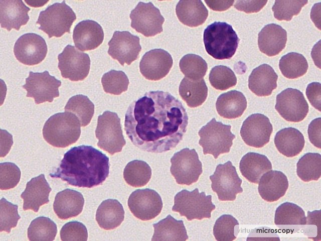 Normal neutrophil - Chronic Lymphocytic Leukaemia
