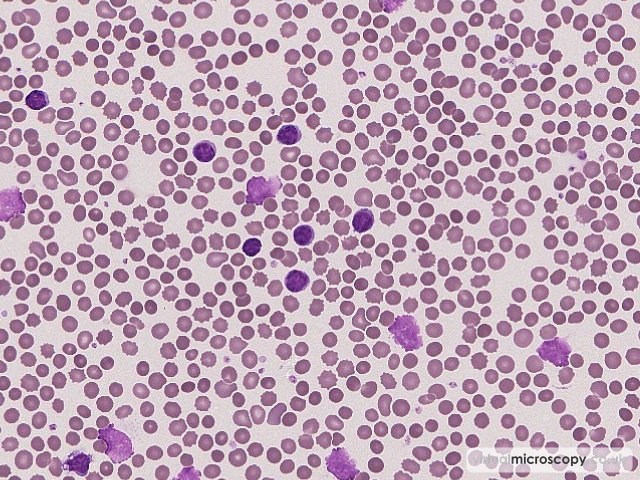 Lymphocytes and Smear Cells - Chronic Lymphocytic Leukaemia