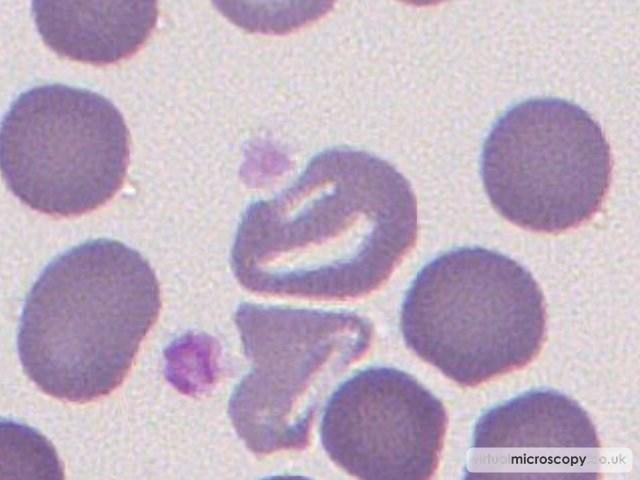 Abnormal Haemoglobinisation - Congenital Sideroblastic Anaemia