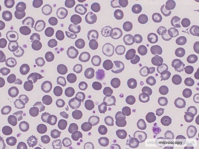 Platelet Anisocytosis - Congenital Sideroblastic Anaemia