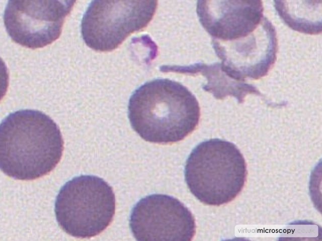 Normal Red Blood Cell - Congenital Sideroblastic Anaemia