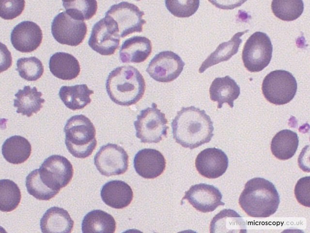 Hypochromic Red Blood Cells - Congenital Sideroblastic Anaemia