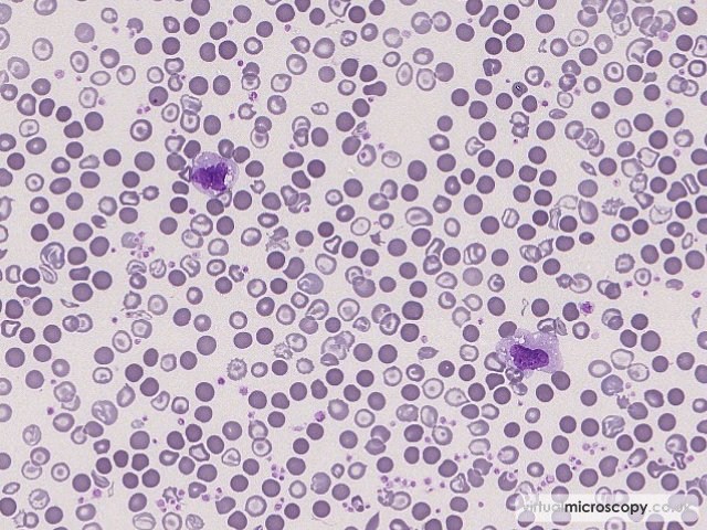 Reactive Monocytes - Congenital Sideroblastic Anaemia