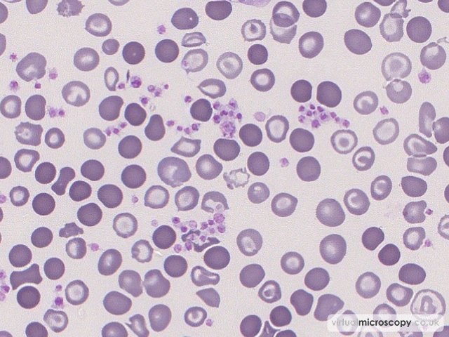 Platelet Clumps - Congenital Sideroblastic Anaemia