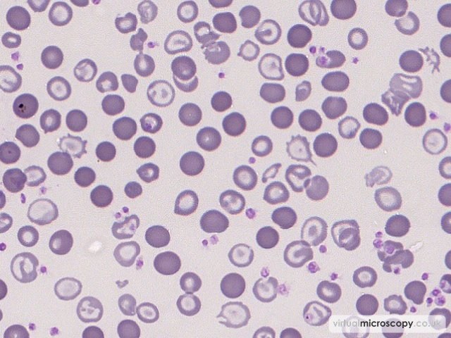 Dimorphic red cell population - Congenital Sideroblastic Anaemia