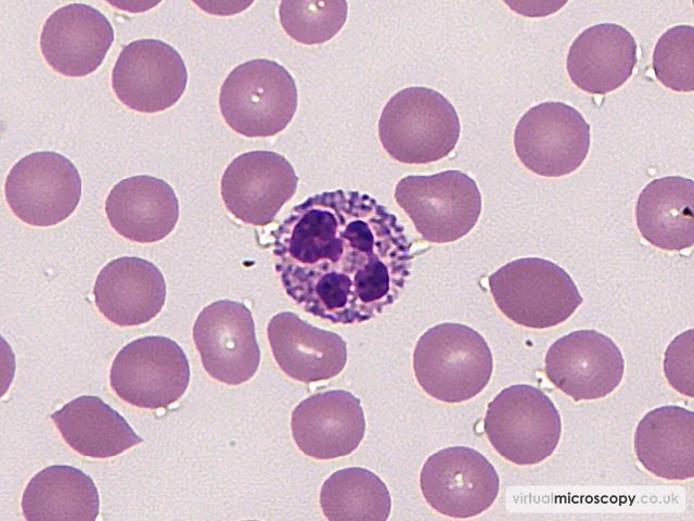 Normal Neutrophil - Immune Mediated Thrombocytopenia (ITP)