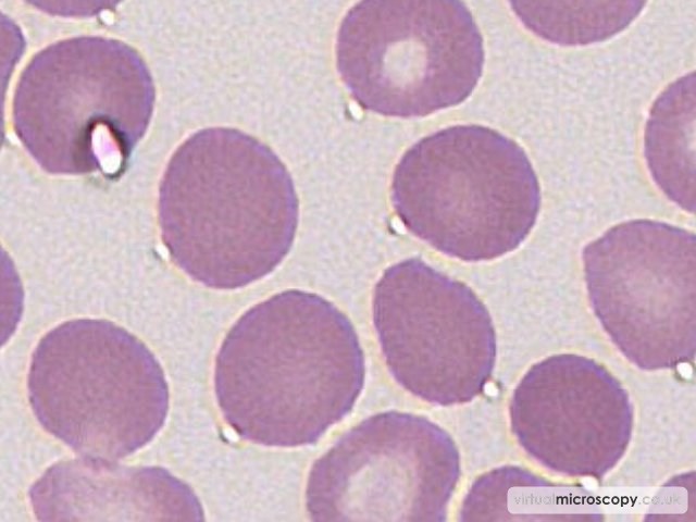 Spherocytes - Autoimmune Haemolytic Anaemia