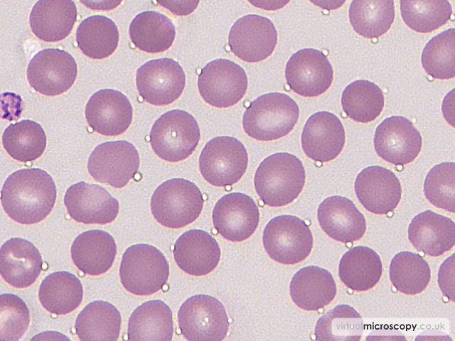Normal Red Blood Cells - Autoimmune Haemolytic Anaemia