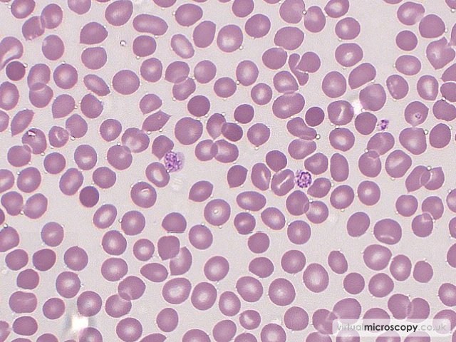 Large Platelets - Autoimmune Haemolytic Anaemia