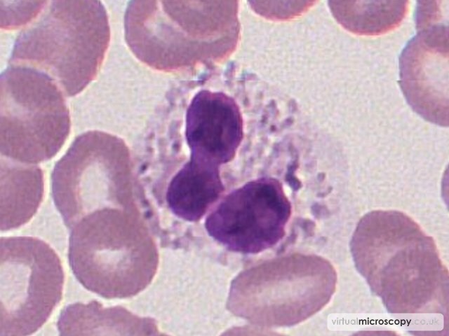 Toxic Granulation in Neutrophil - Autoimmune Haemolytic Anaemia