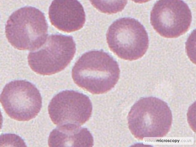 Stomatocyte - Autoimmune Haemolytic Anaemia