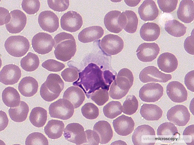 Reactive lymphocyte - Autoimmune Haemolytic Anaemia
