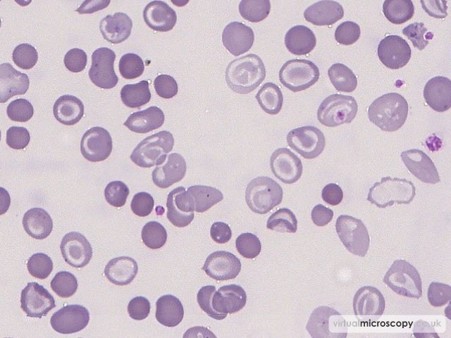 Hypochromic Microcytic Red Blood Cells - Beta Thalassaemia Intermedia post Transfusion