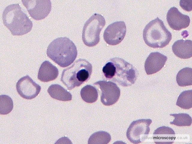 Abnormal nRBC - Beta Thalassaemia Intermedia post Transfusion