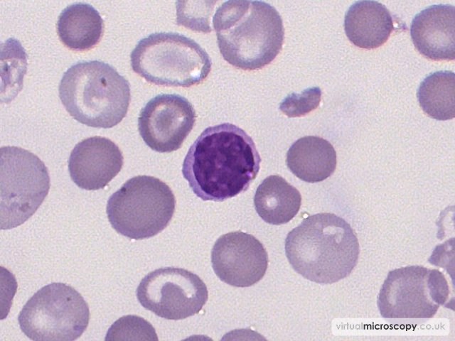 Normal Lymphocyte - Beta Thalassaemia Intermedia post Transfusion