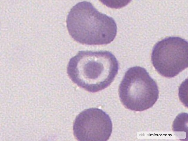 Target Cell - Beta Thalassaemia Intermedia post Transfusion