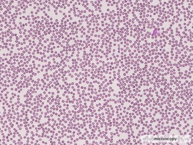 Normal Red Cell Morphology - Immune Mediated Thrombocytopenia (ITP)