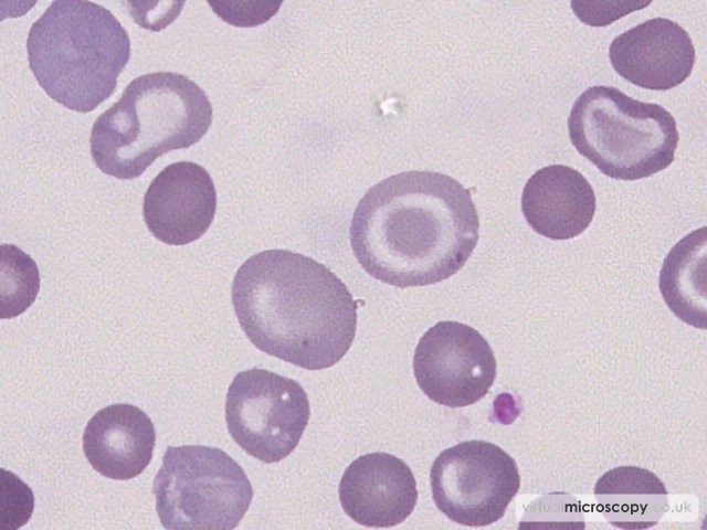 Reticulocytes - Beta Thalassaemia Intermedia post Transfusion