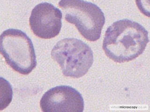 Basophillic Stippling - Beta Thalassaemia Intermedia post Transfusion