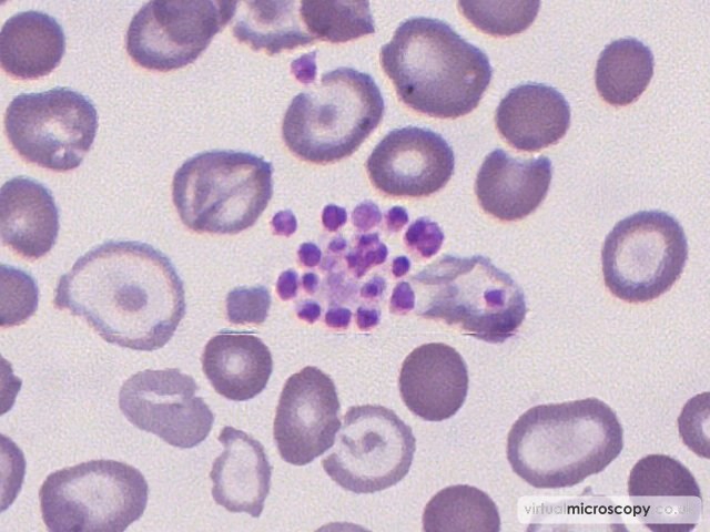 Platelet Clump - Beta Thalassaemia Intermedia post Transfusion