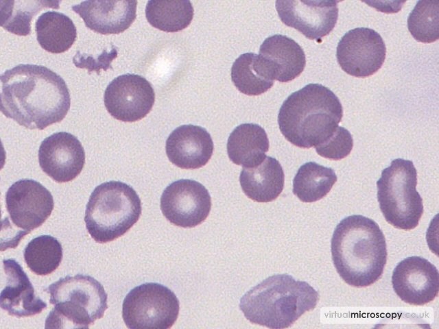 Transfused Normal RBC - Beta Thalassaemia Intermedia post Transfusion