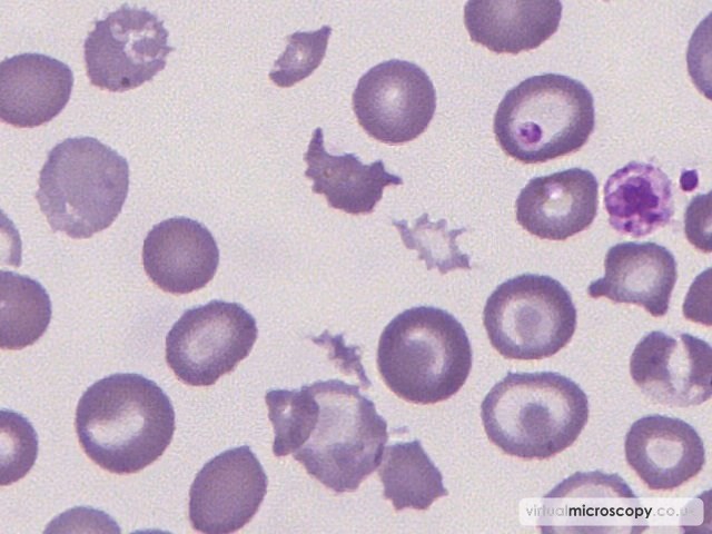 Extreme RCAP - Beta Thalassaemia Intermedia post Transfusion