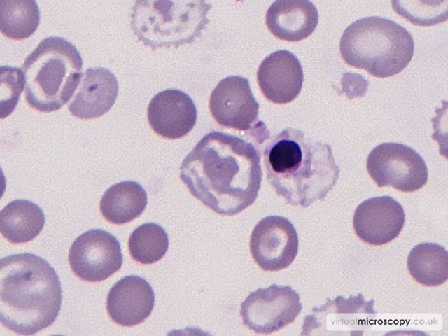 Abnormal Haemoglobinisation - Beta Thalassaemia Intermedia post Transfusion