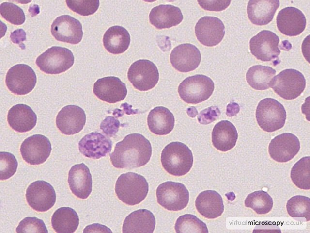 Thrombocytosis with Anisocytosis - Essential Thrombocytosis