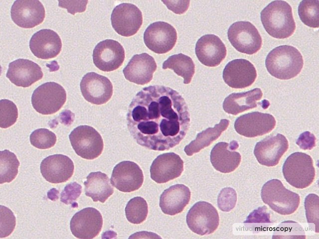 Toxic Granulation - Essential Thrombocytosis