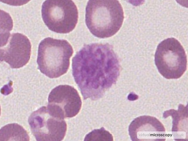 Giant Platelet - Essential Thrombocytosis