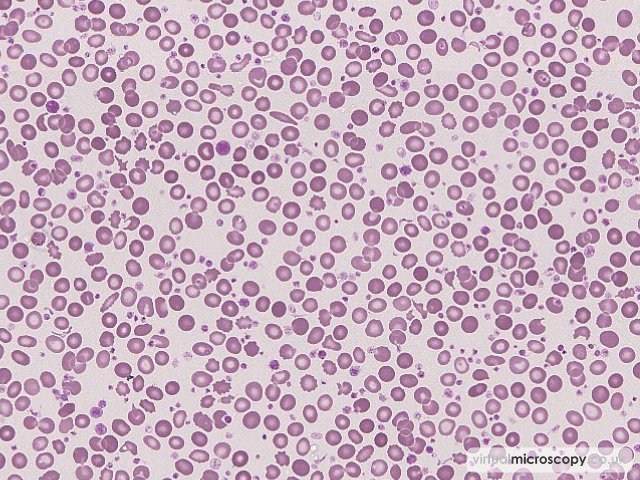 Mild RCAP - Essential Thrombocytosis